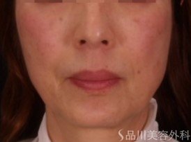 症例NO.73531のBEFORE写真