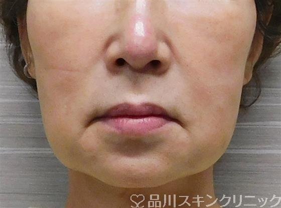 症例NO.56338のBEFORE写真