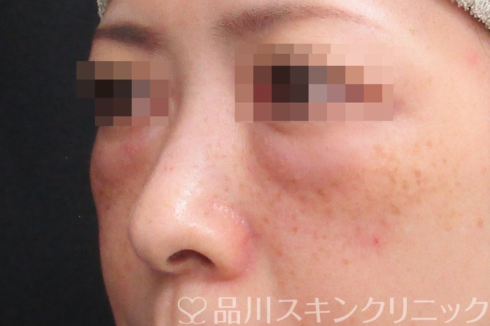 症例NO.75097のAFTER写真