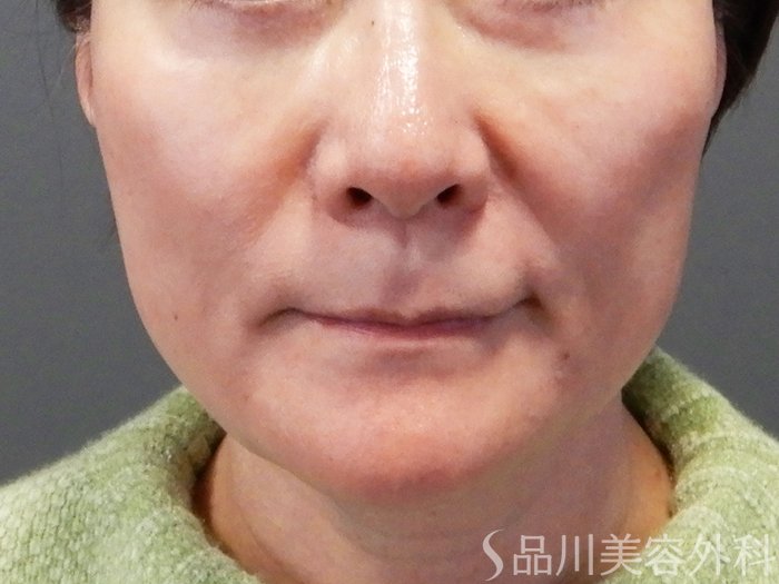 症例NO.73269のAFTER写真