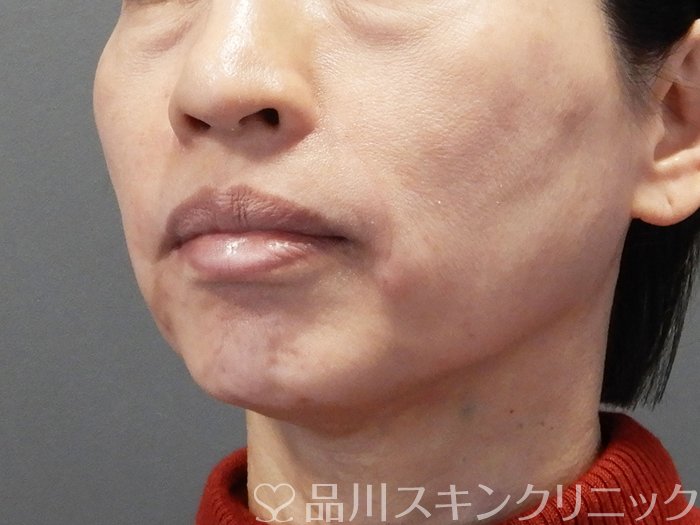 症例NO.72853のAFTER写真