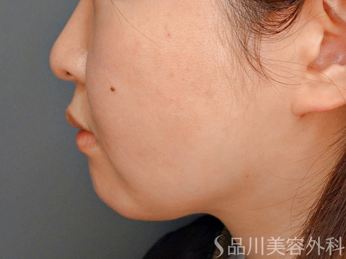 症例NO.73744のAFTER写真