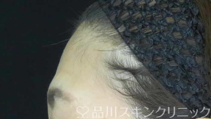 症例NO.71933のBEFORE写真