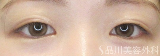 症例NO.69419のBEFORE写真