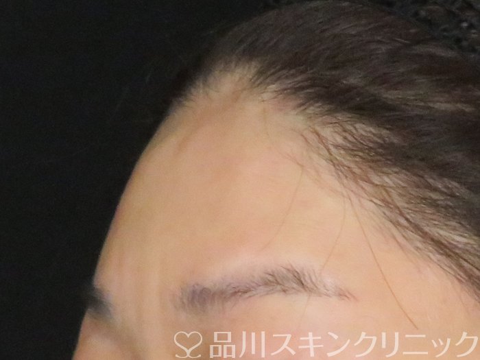症例NO.65425のAFTER写真
