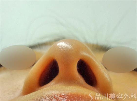 症例NO.25958のBEFORE写真