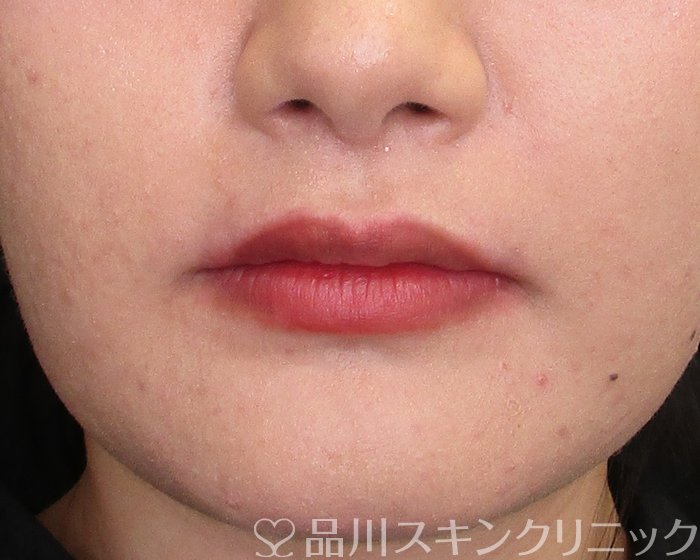 症例NO.74148のAFTER写真