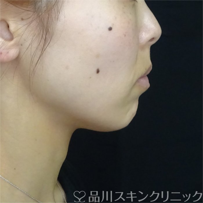 症例NO.70166のBEFORE写真