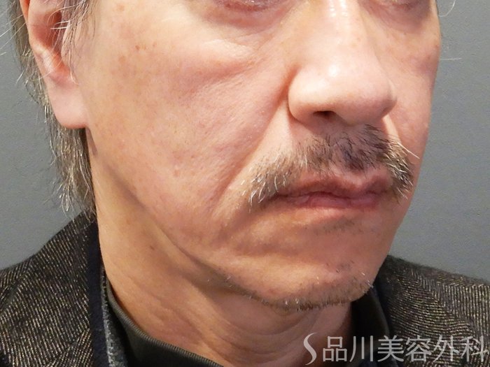 症例NO.70468のBEFORE写真