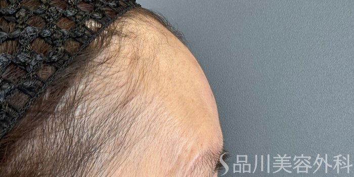 症例NO.65602のAFTER写真