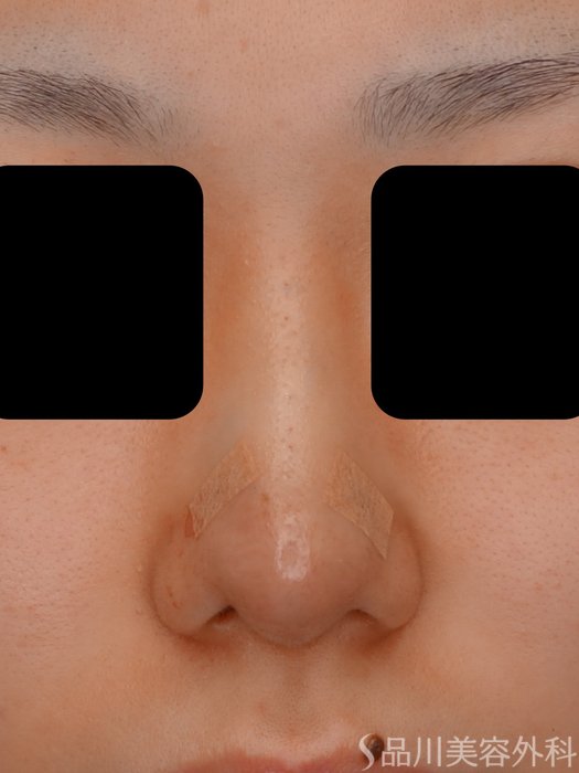 症例NO.73593のAFTER写真