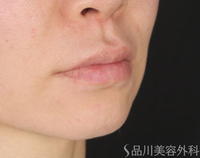 症例NO.73756のBEFORE写真