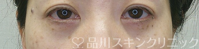 症例NO.69346のAFTER写真