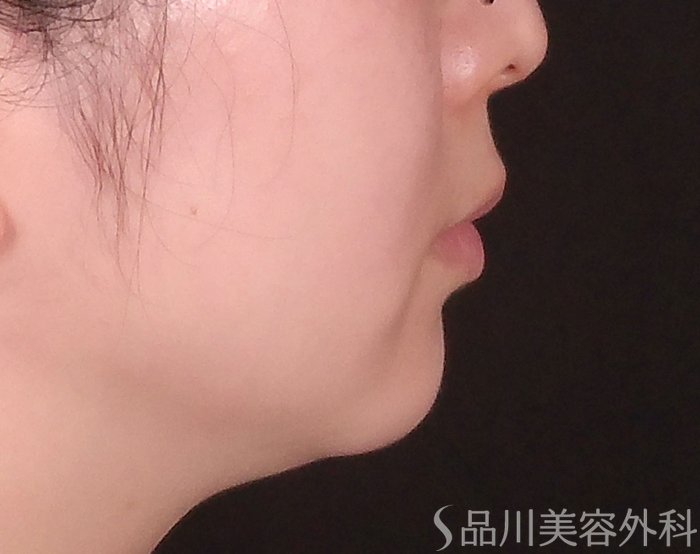 症例NO.69476のBEFORE写真