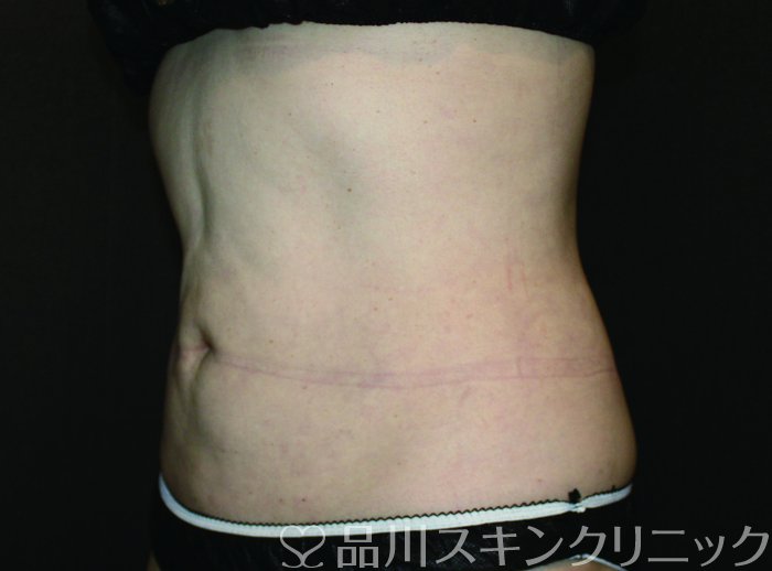 症例NO.69686のAFTER写真