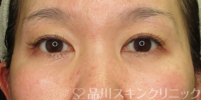 症例NO.70542のAFTER写真