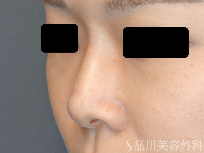 症例NO.70928のAFTER写真
