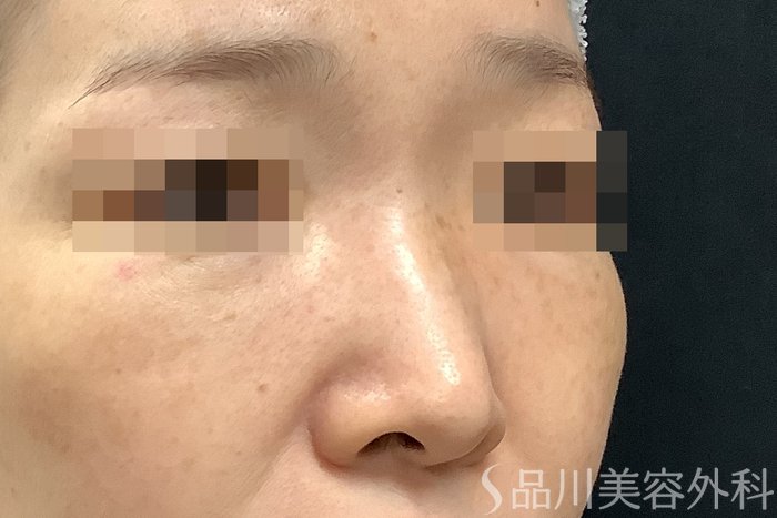 症例NO.71256のBEFORE写真