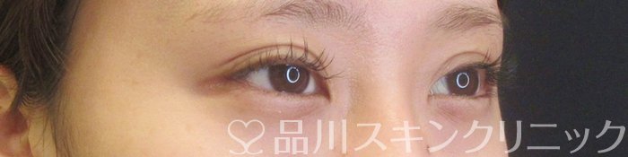 症例NO.68626のAFTER写真