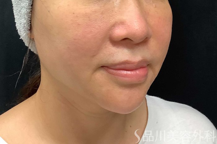症例NO.69917のBEFORE写真