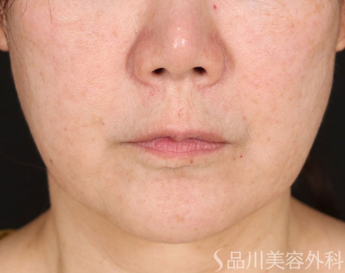 症例NO.71022のBEFORE写真