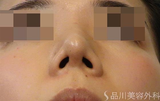 症例NO.39898のAFTER写真