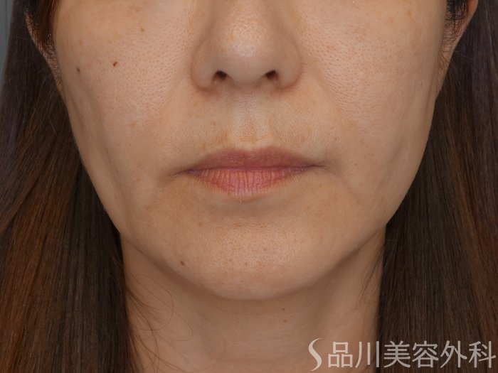 症例NO.69869のBEFORE写真