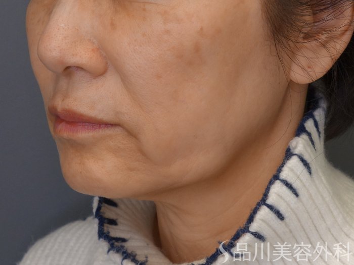 症例NO.69359のBEFORE写真