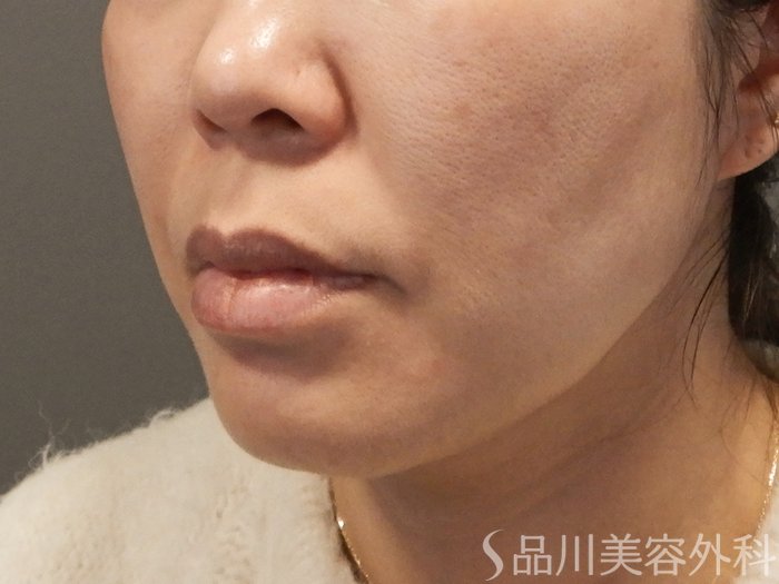 症例NO.69598のBEFORE写真