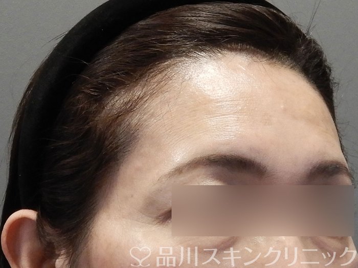 症例NO.74757のBEFORE写真