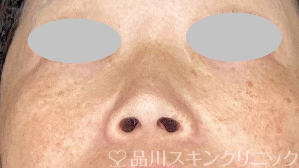 症例NO.63100のBEFORE写真