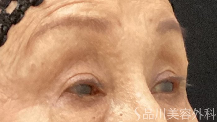 症例NO.69511のAFTER写真