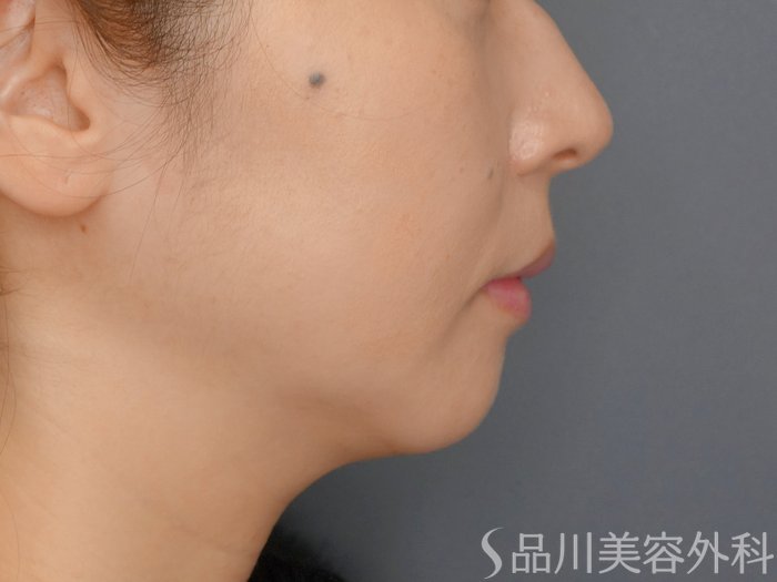 症例NO.73287のAFTER写真