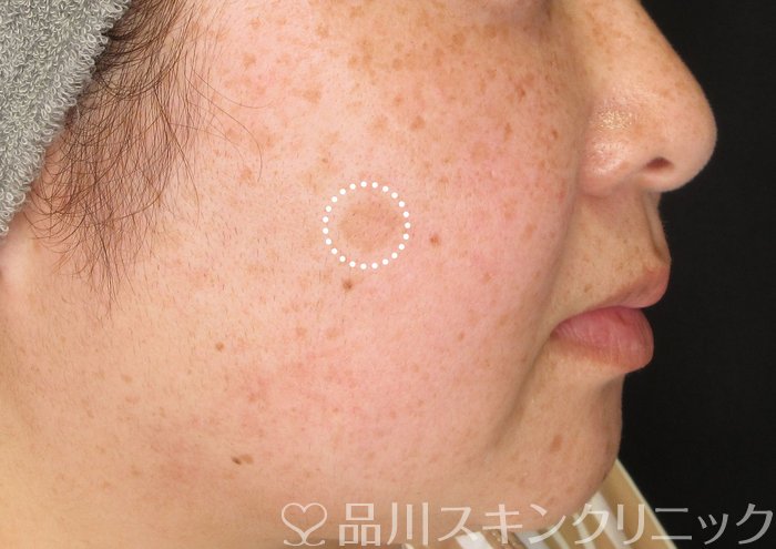 症例NO.73929のBEFORE写真
