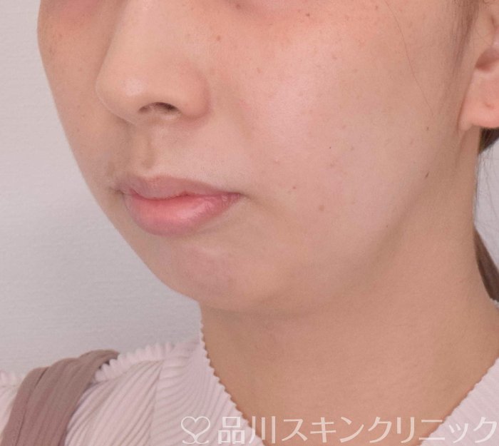 症例NO.69318のBEFORE写真