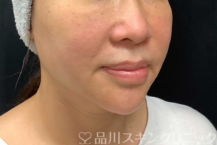 症例NO.69917のBEFORE写真