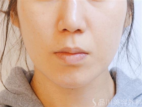 症例NO.39395のAFTER写真