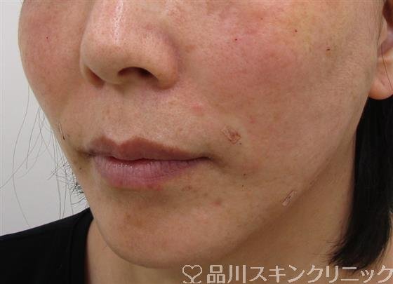 症例NO.37888のAFTER写真