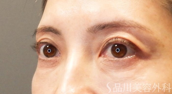 症例NO.69496のAFTER写真
