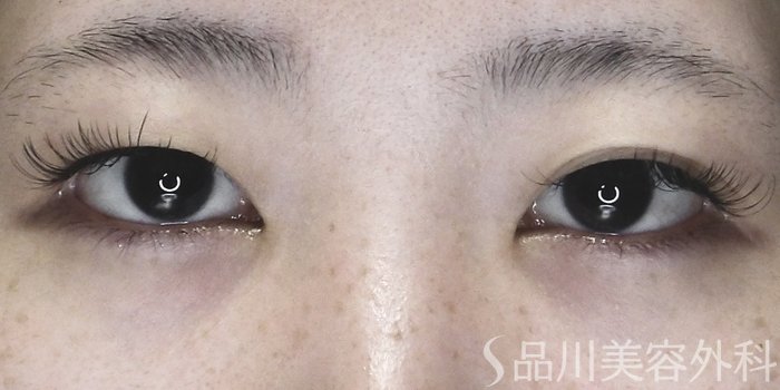 症例NO.70478のBEFORE写真