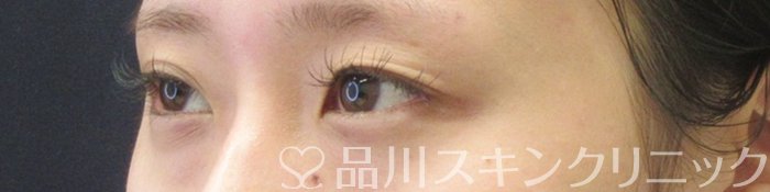 症例NO.68626のBEFORE写真