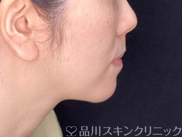 症例NO.70154のAFTER写真