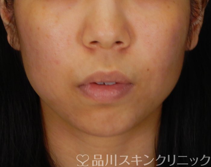 症例NO.67482のBEFORE写真