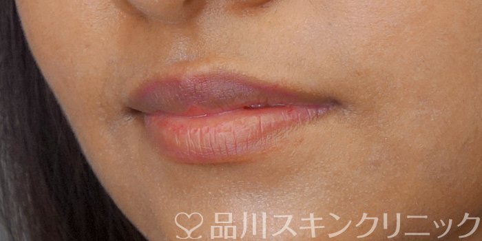 症例NO.72221のBEFORE写真