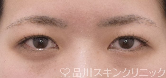 症例NO.71183のBEFORE写真