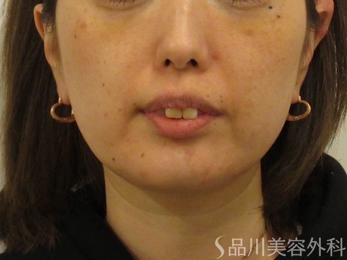 症例NO.74559のBEFORE写真