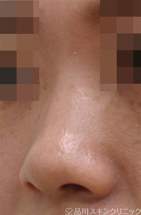 症例NO.42153のBEFORE写真