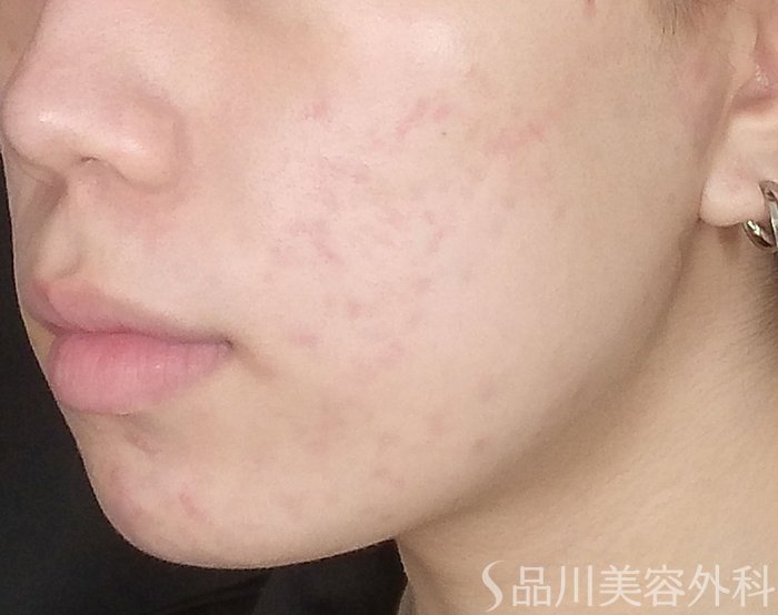 症例NO.72189のAFTER写真