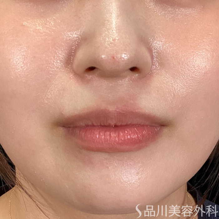 症例NO.65236のBEFORE写真