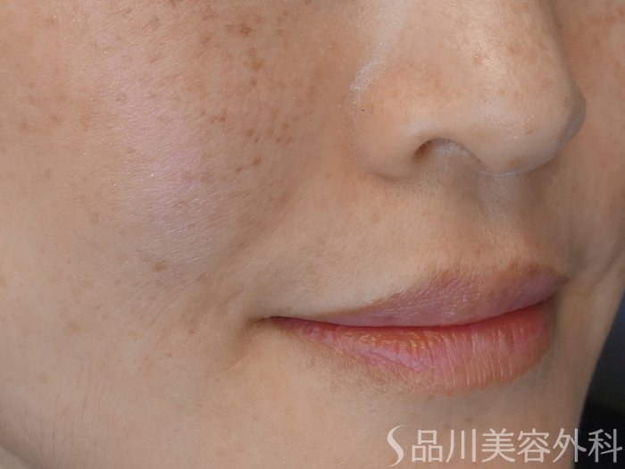 症例NO.68201のAFTER写真